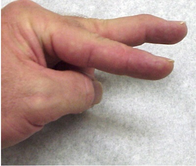 TRAUMATOLOGIA Y REUMATOLOGIA DE LA MUÑECA Y MANO (60 horas) (Tenerife)
